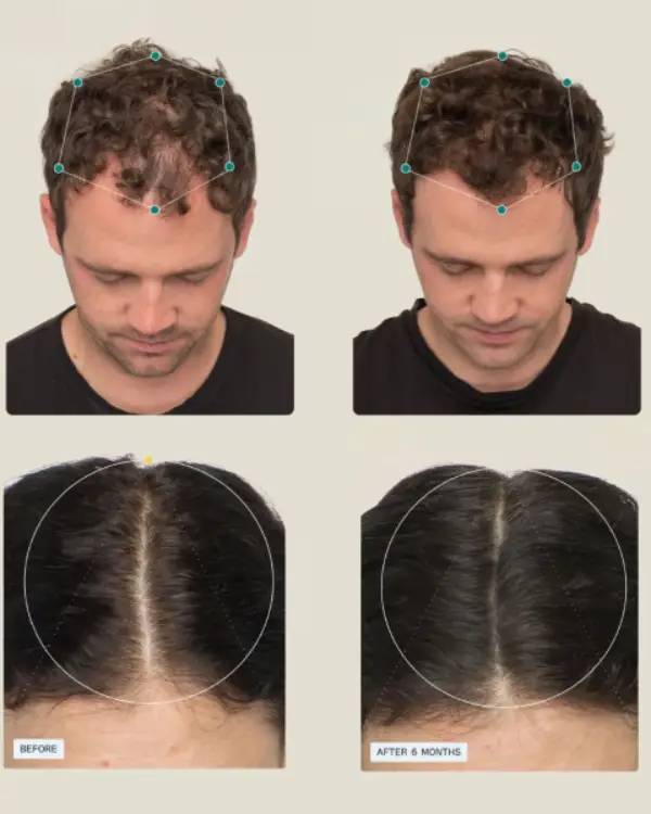 Nutrafol Before and After